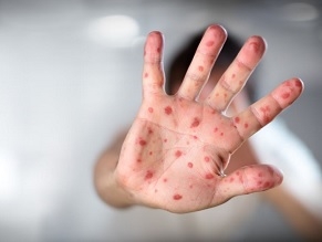 Measles outbreak started in Ukraine, traveled to Israel, Brooklyn