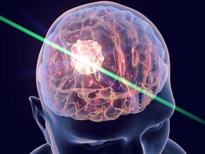 В Израиле впервые удалили опухоль мозга с помощью лазера